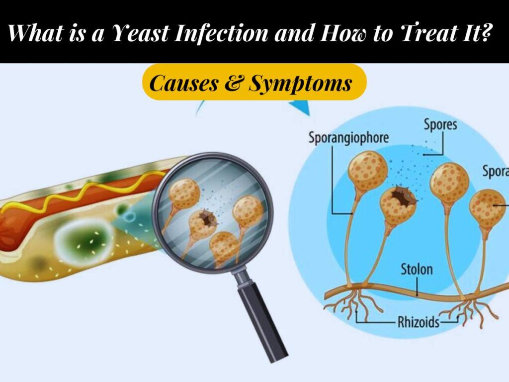 What is a Yeast Infection and How to Treat It? Causes & Symptoms